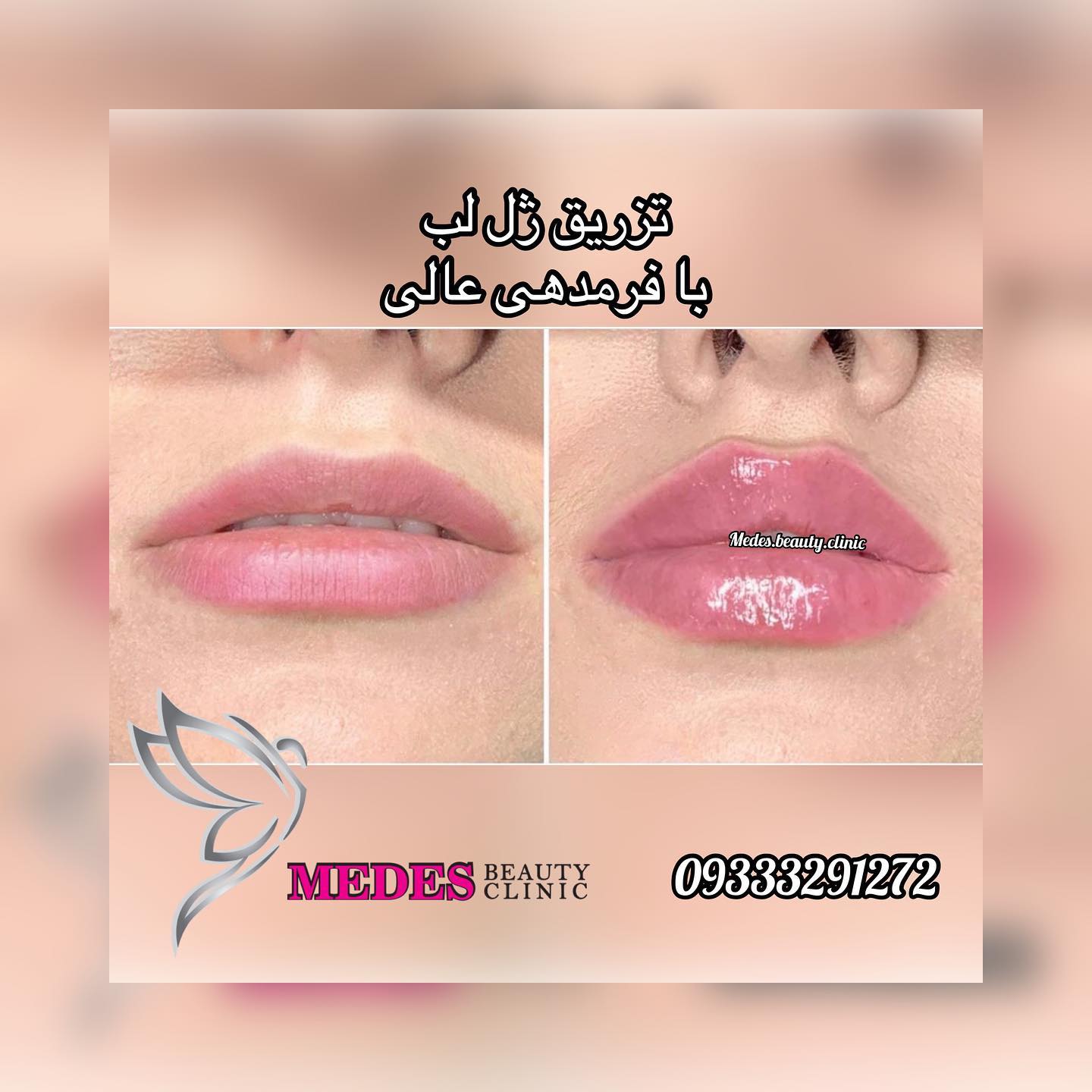 گالری تزریق ژل لب